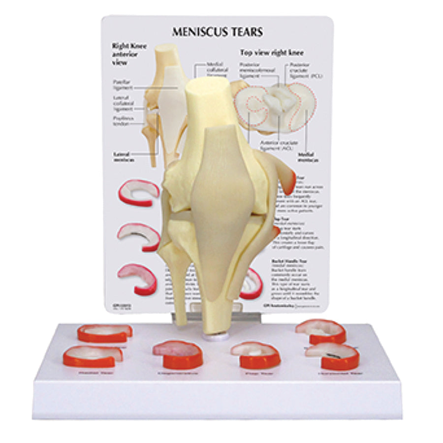 Meniscus Tears of the Knee Model